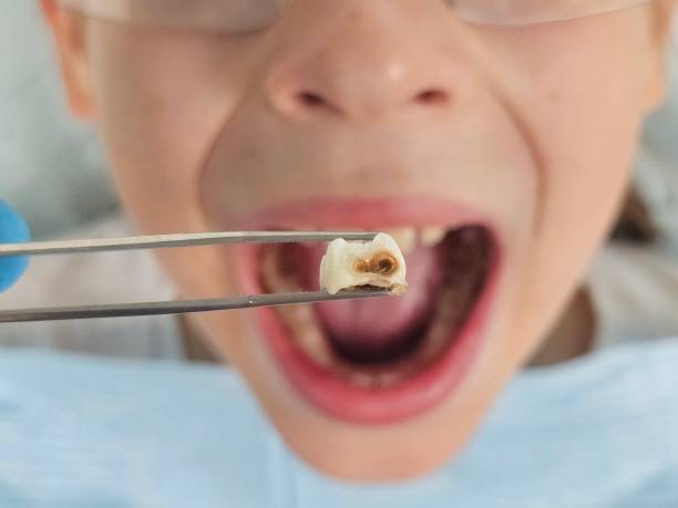 Best Emergency Broken Tooth Repair in Macungie, PA